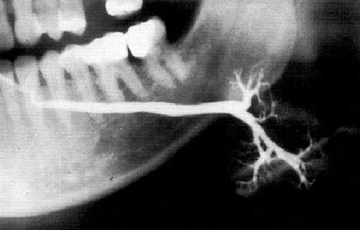 Describe The Radiological Finding
