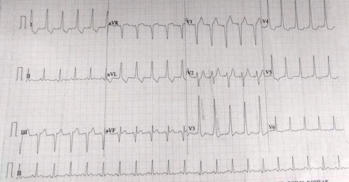 Identify The Condition In ECG
