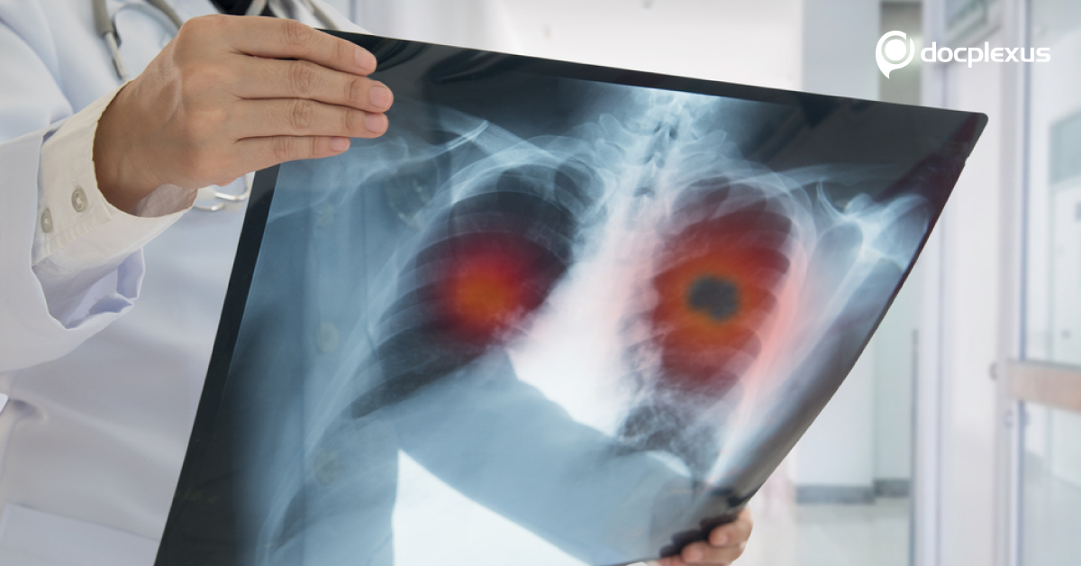 Lung Cancer Vs Pneumonia, Signs And Symptoms