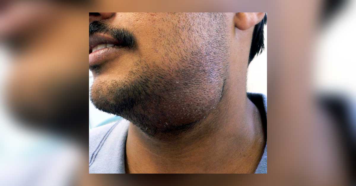 Enlarged Submandibular Salivary Glands