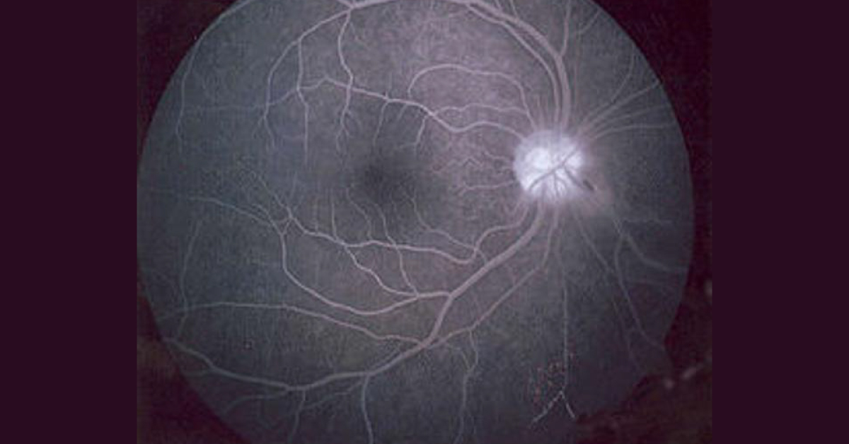 Brief Scenario Of Uses Of Fluorescein In Ophthalmology
