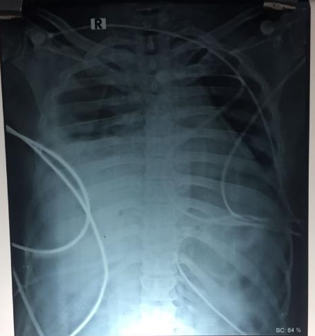 Find Out Story, What These Serial X-ray Chest Are Depicting? 