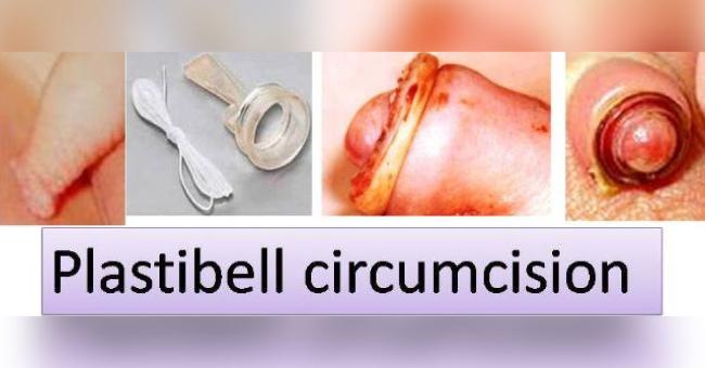Circumplast CircumcisionA NOVEL DISPOSABLE DEVICE FOR MALE CHILDREN  CIRCUMCISION