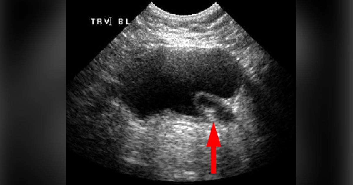 Identify This Urological Disorder