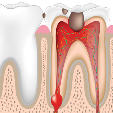 Tooth Decay Risk Factors