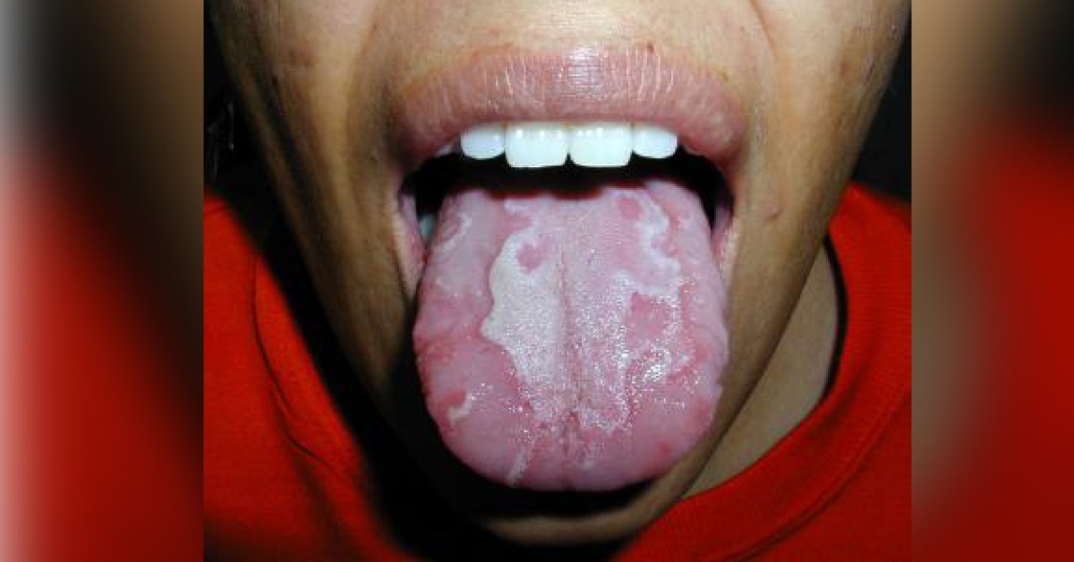 Identify This Oral Condition