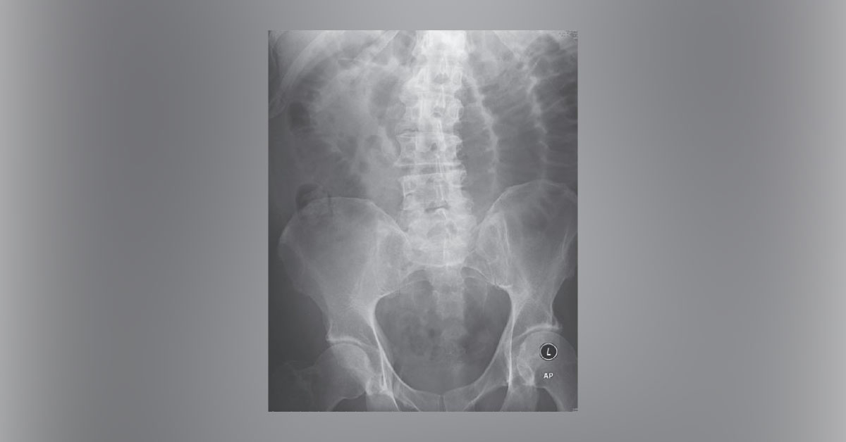 Vomiting After Laparotomy