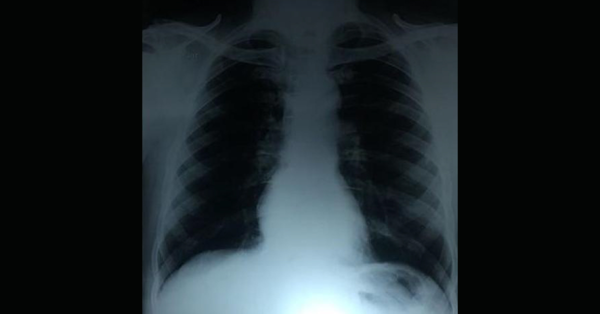 What Is This Development In X-ray Chest After Twenty Days? 