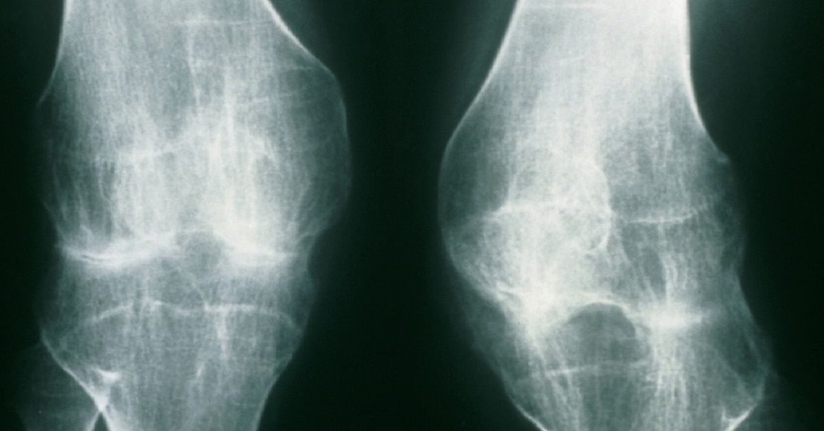 Juvenile Enthesitis-Related Arthritis: Anti-TNF Agents Vs DMARDs