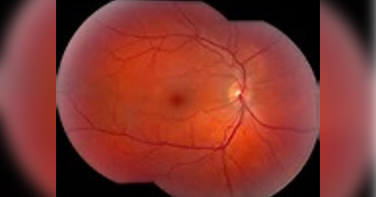 Central Serous Retinopathy: A Brief Review