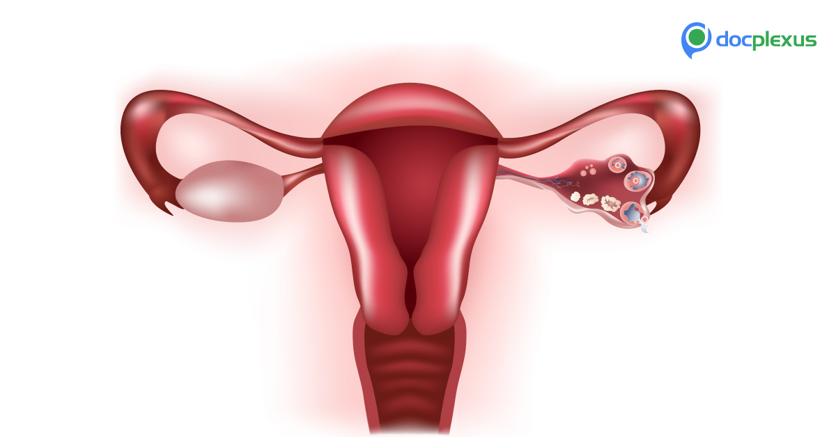 Balloon Thermal Endometrial Ablation: Benefits and Risks