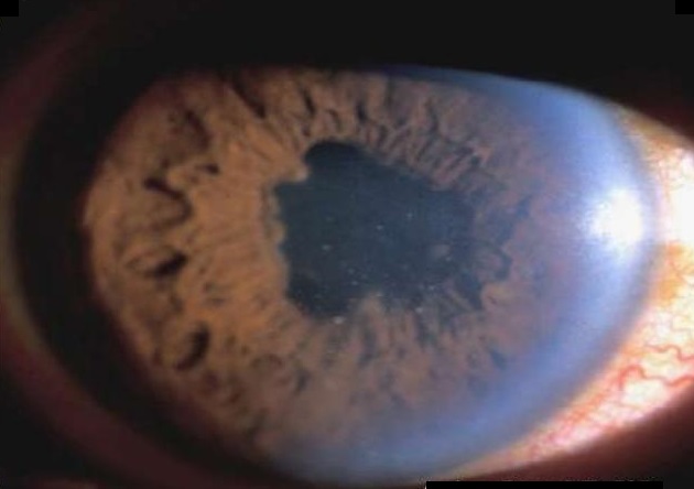 A Brief Scenario Of Posner-schlossman Syndrome Or Hypertensive Iridocycltis Crysis