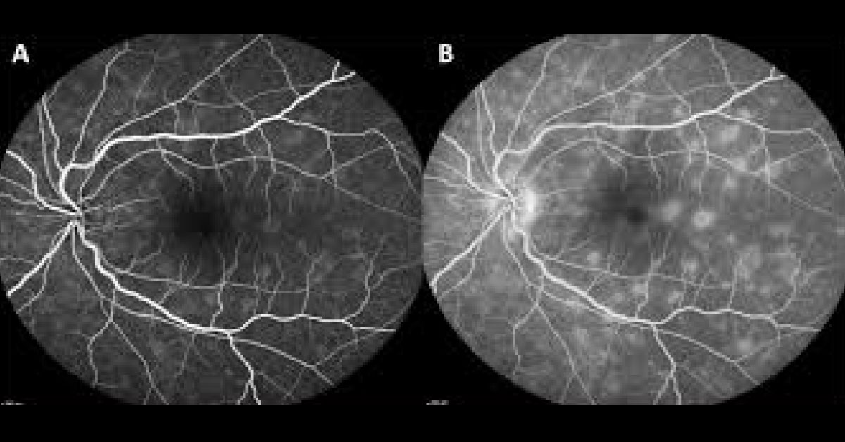 Brief Review On White Dot Syndrome