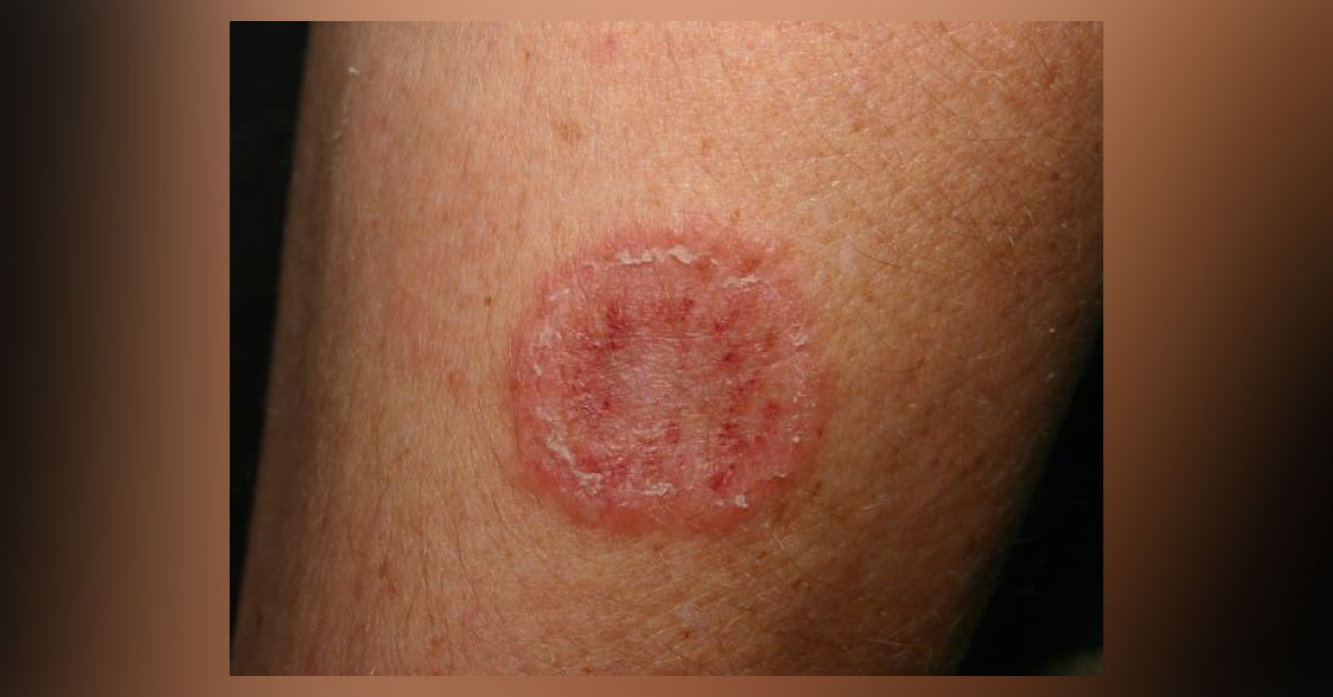 Starting oral therapy in a case of superficial dermatophytes keeping legal implications in mind