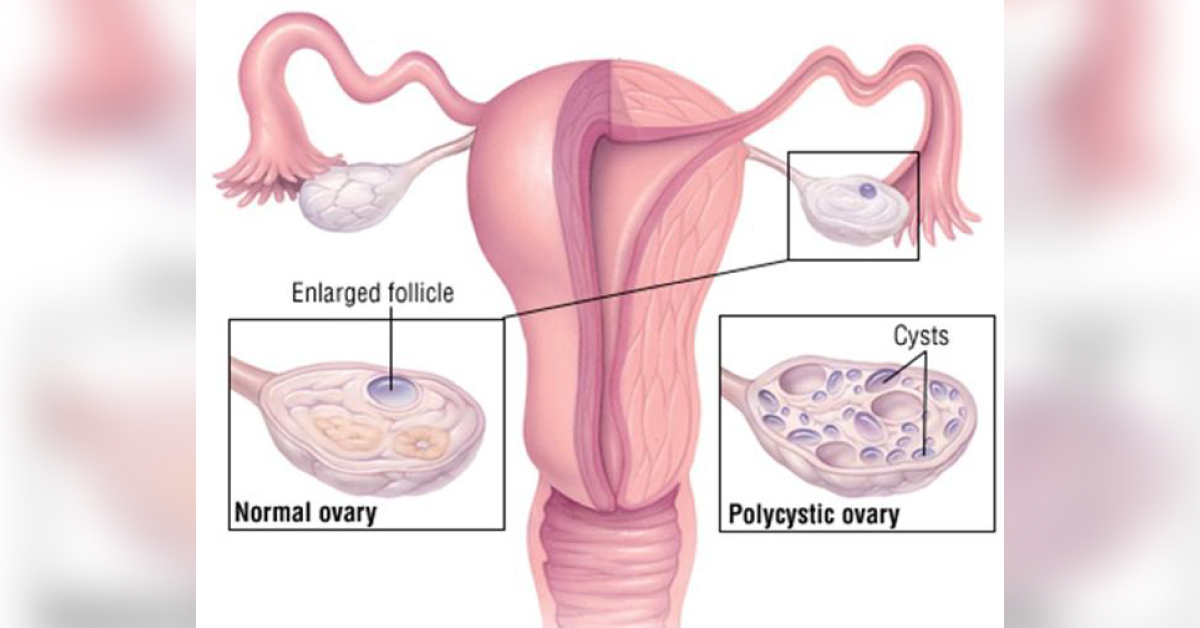 Polycystic Ovary Syndrome: A Ravana With Many Heads