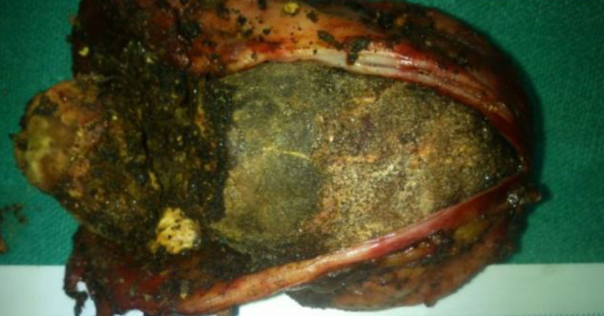 Huge Gall Stone 9*4 Cm Removed Laparoscopically