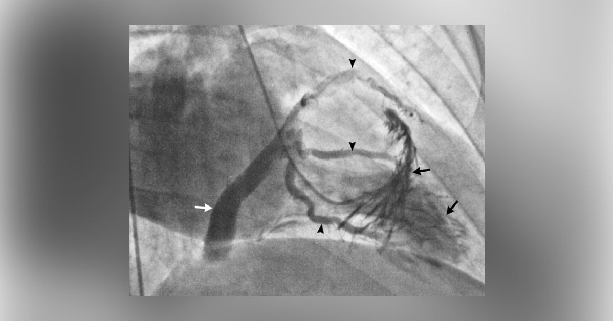 Identify Veins Pointed By The Black Arrows