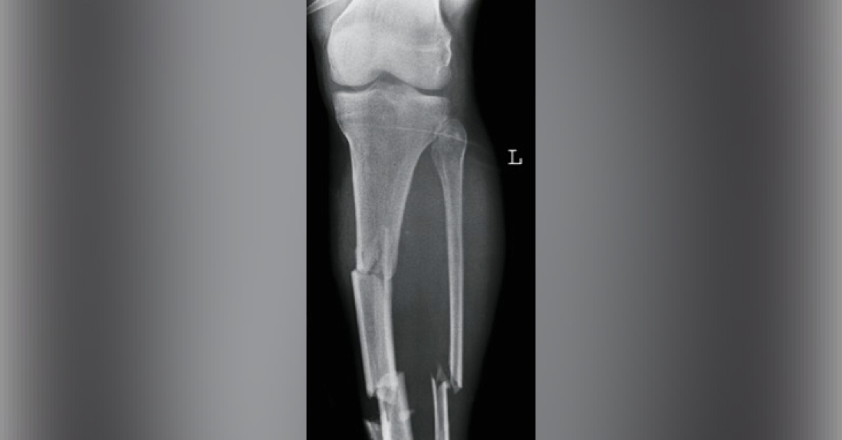A Case Of Orthopedic Trauma