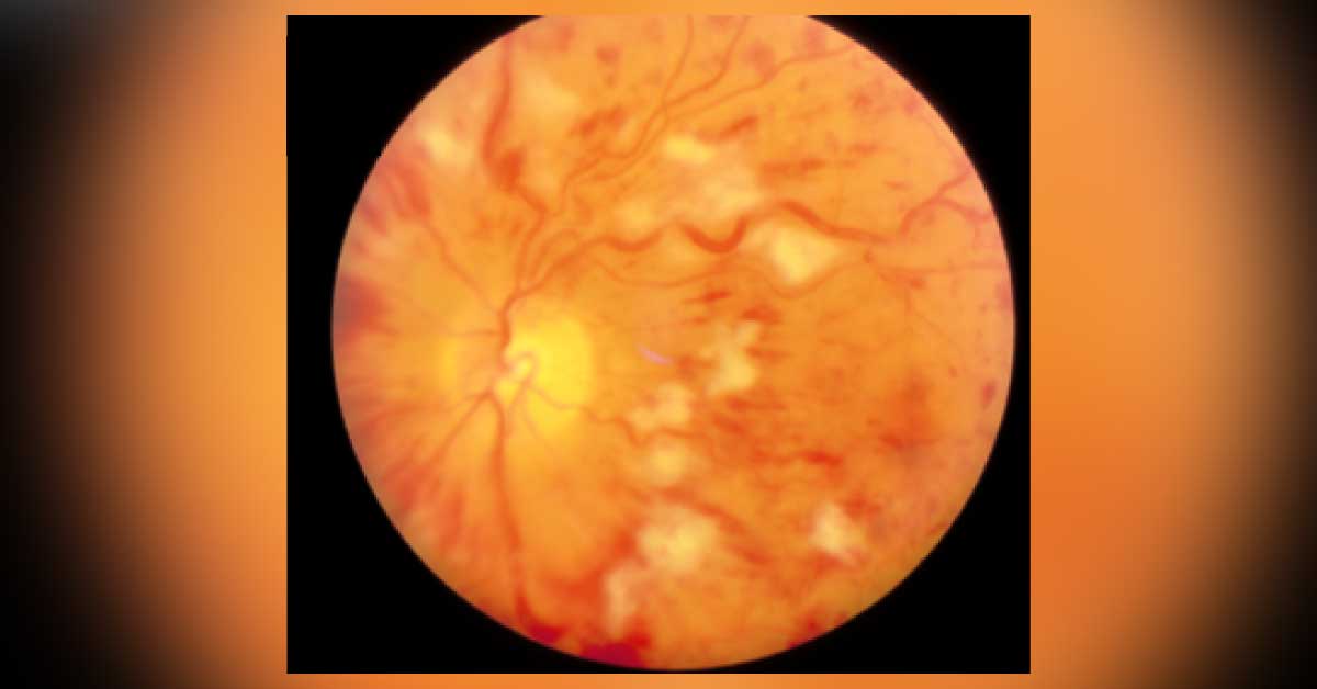 Identify This Ophthalmology Condition