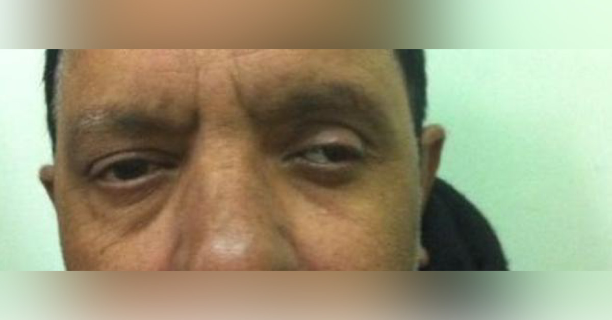 A Brief Review Of Keratoconus And Its Associations