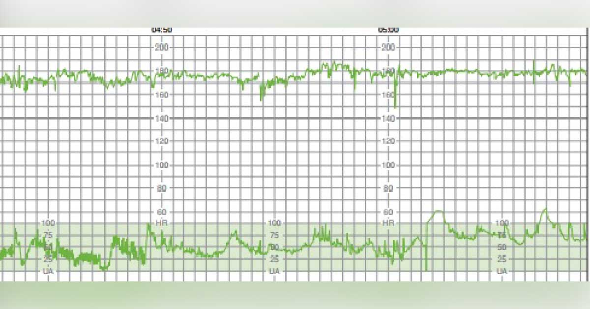 Fever And Abdominal Discomfort In Pregnancy