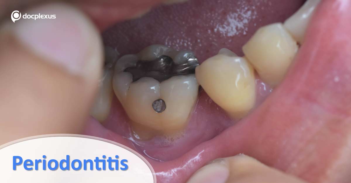 Antibiotic Therapy For Aggressive Periodontitis
