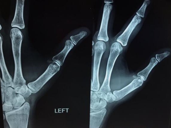 What Happened To 1st Metacarpo- Phalangeal Joint?