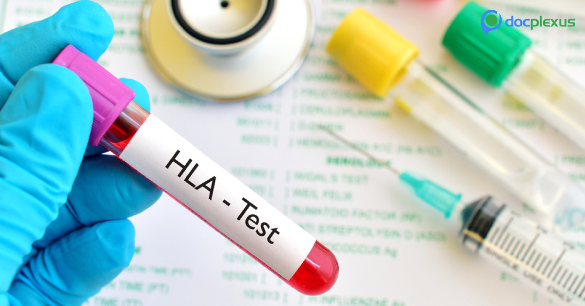 HLA-B27 Test – All You Need To Know