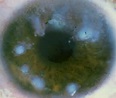 Very Brief Review Of Salzmann's Nodular Corneal Degeneration