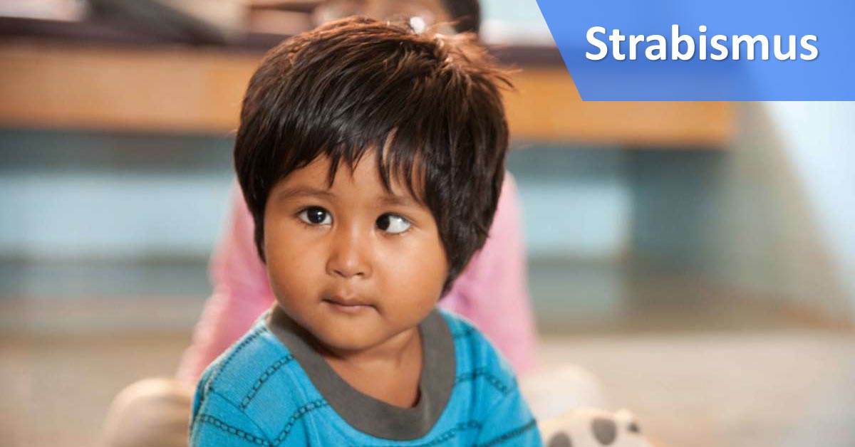 Strabismus in Childhood, Diagnosis and Management Guideline