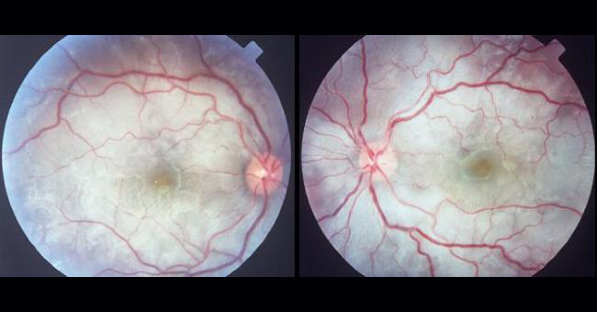 Very Brief Review Of Vogt Koyanagi Harada Syndrome
