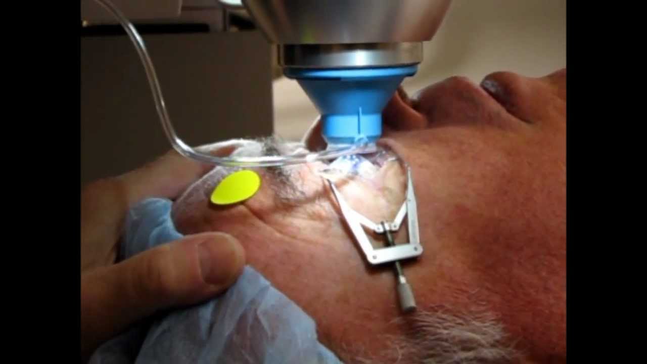 Indications Of Laser In Ophthalmology