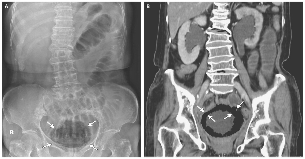 Identify This Condition In A Diabetic Woman