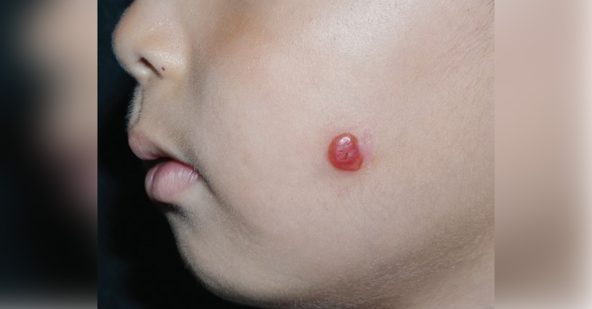 A Pink Nodule On Cheek