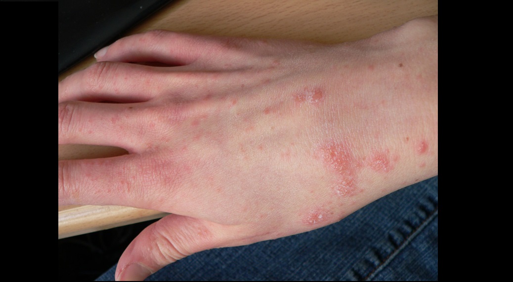 Scabies: Guideline for The Management
