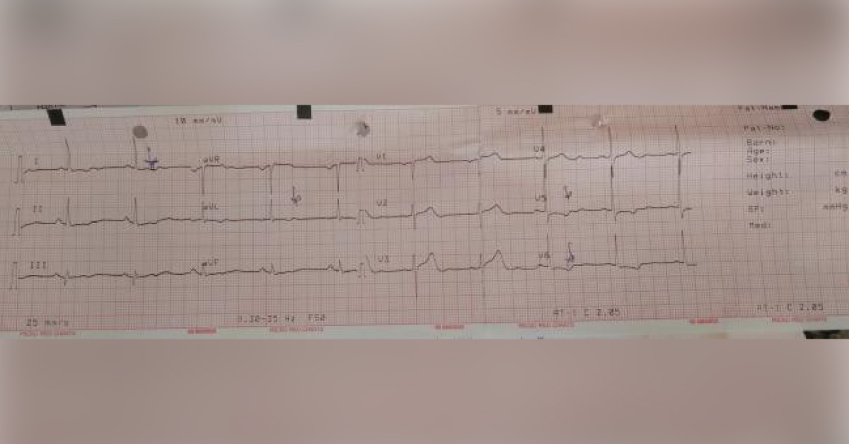 Chest Pain In A Old Man