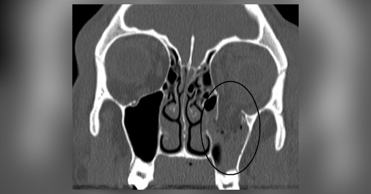A Brief Review Of Blowout Orbital Fracture