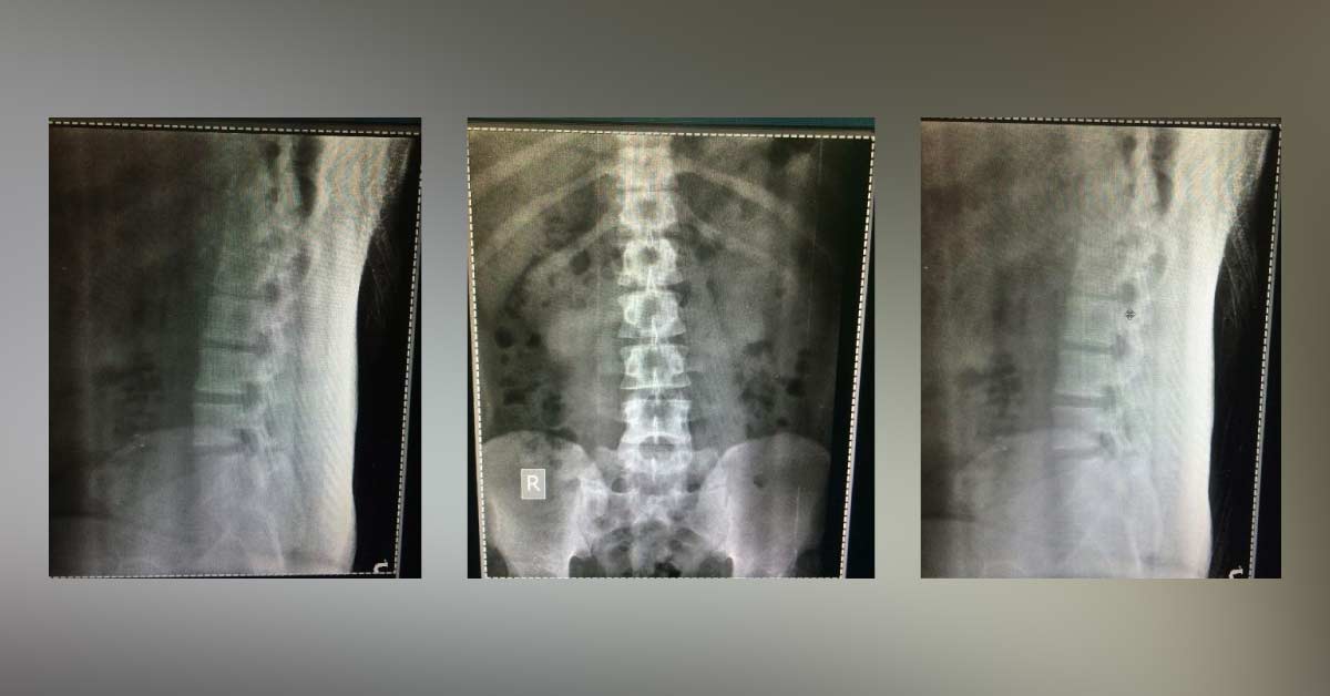 Cause And Line Of Action For Backache