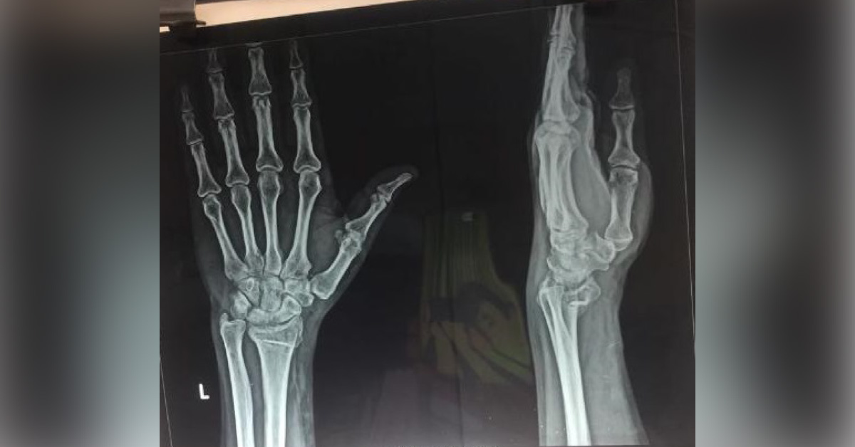 Is This Fracture Is Fully Healed Or Not? 