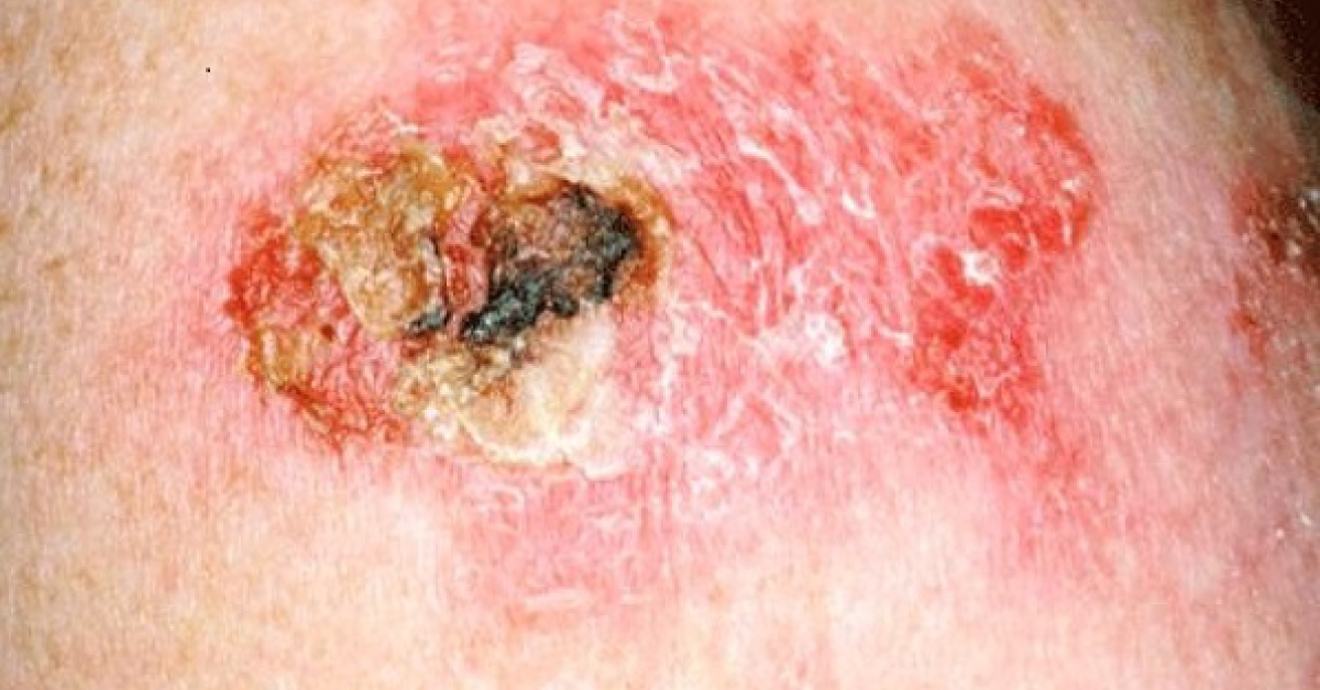 Actinic Keratoses: BAD Management Recommednations