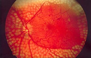 Ocular Manifestations Of Diabetes Mellitus