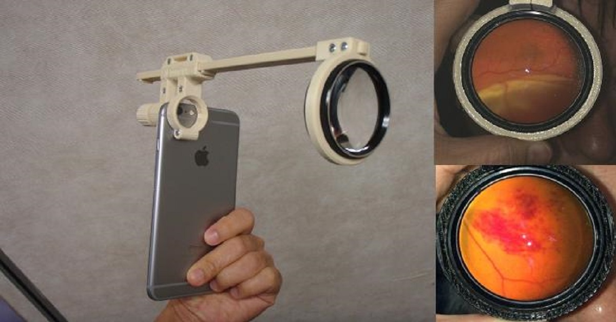 Smart Phones For Fundus Imaging