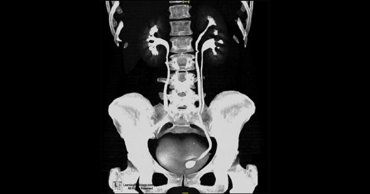 Rectify The Condition From CT