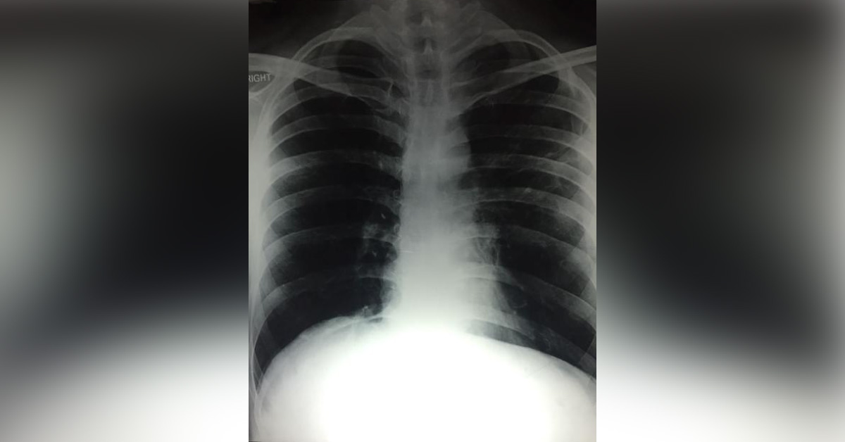 What Are These X-ray's Of PNS and Chest Indicating?