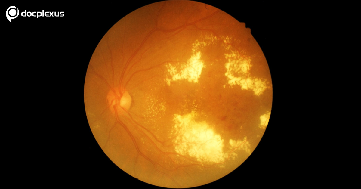 Prevalence And Significance Of Retinopathy