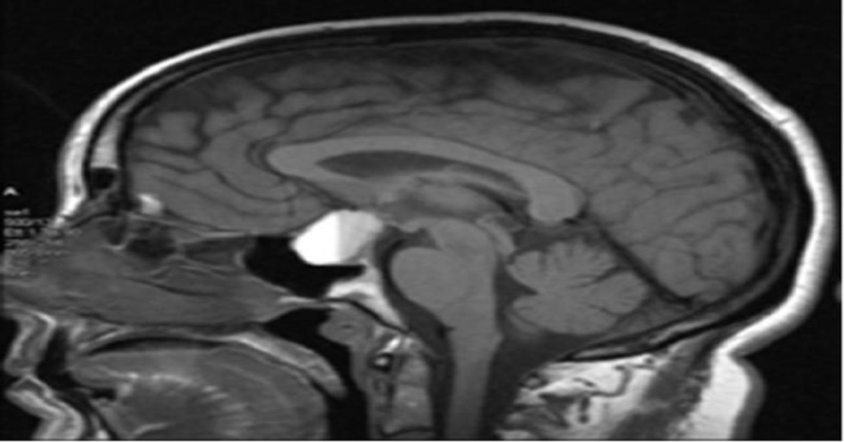 Management Options For Non Functioning Pituitary Adenomas
