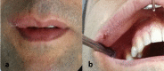 Recurrent Swelling On The Upper Lip