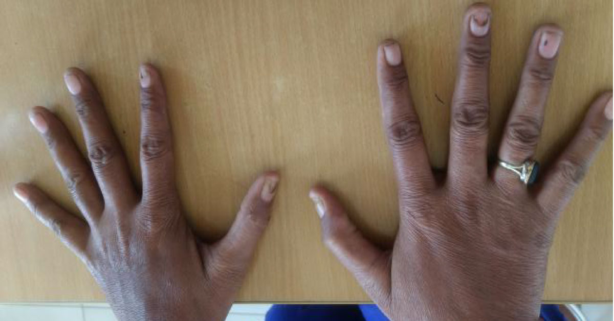 Nail Changes Associated With Hyperthyroidism