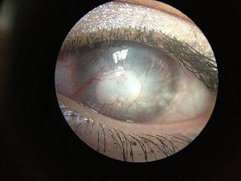 Very Brief Scenario Of Vascularization Of Cornea