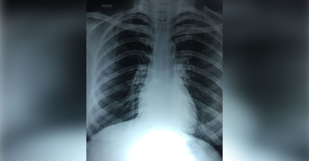 What Is The Cause Of Cough For 9 Months